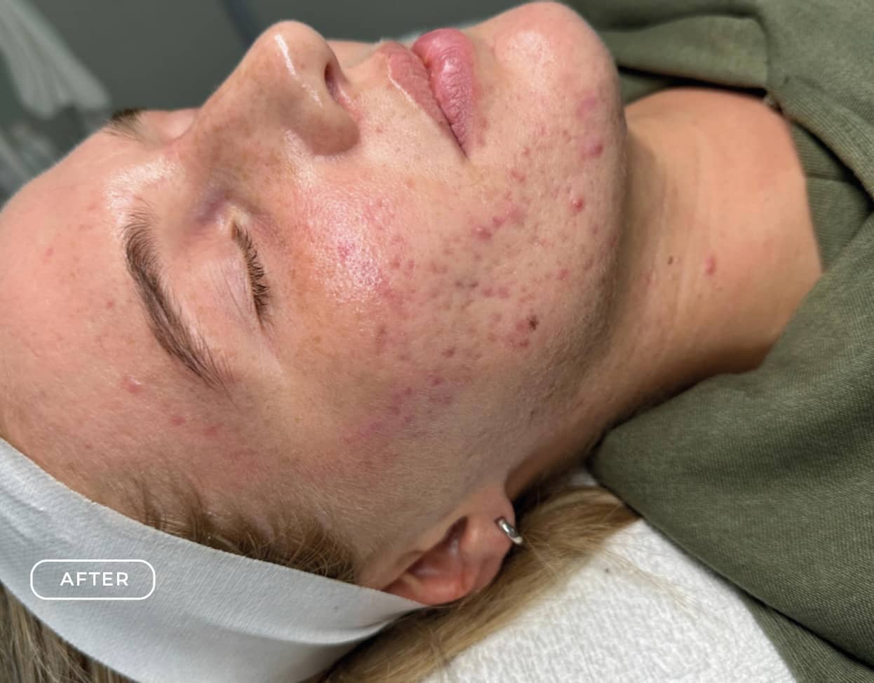 Nachher - Aknebehandlung Akne