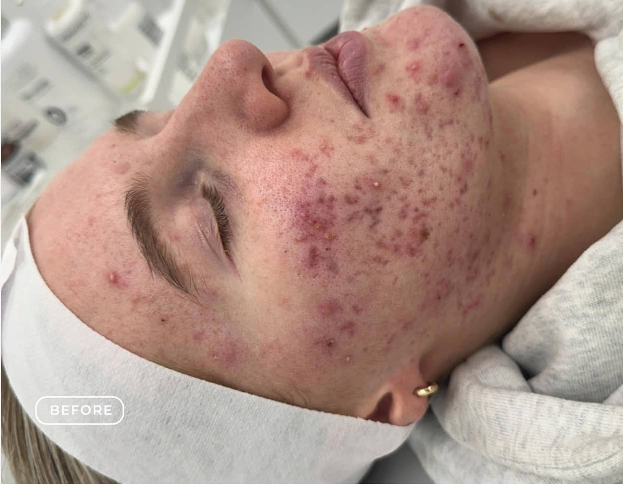 Vorher - Aknebehandlung Akne