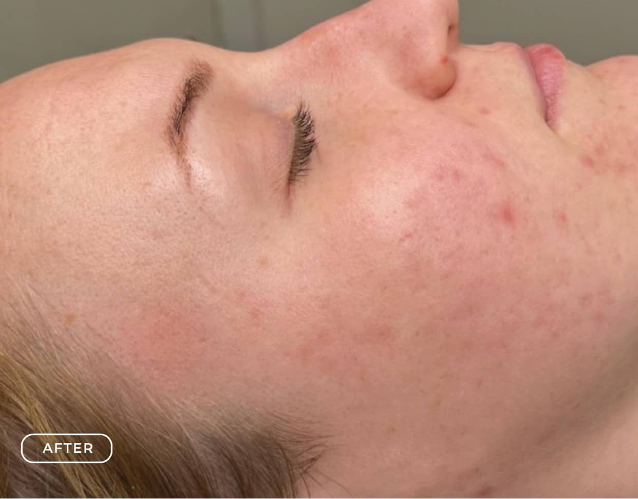 Nachher - Aknebehandlung Akne