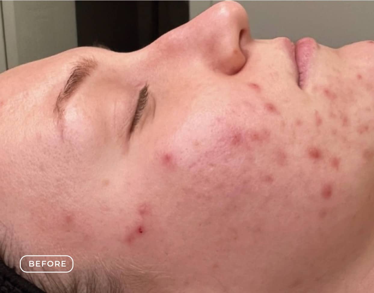Vorher - Aknebehandlung Akne