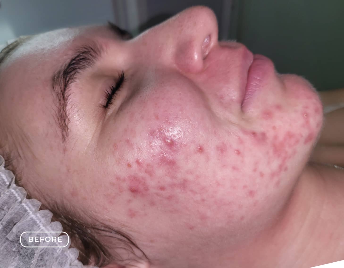 Vorher - Aknebehandlung Akne