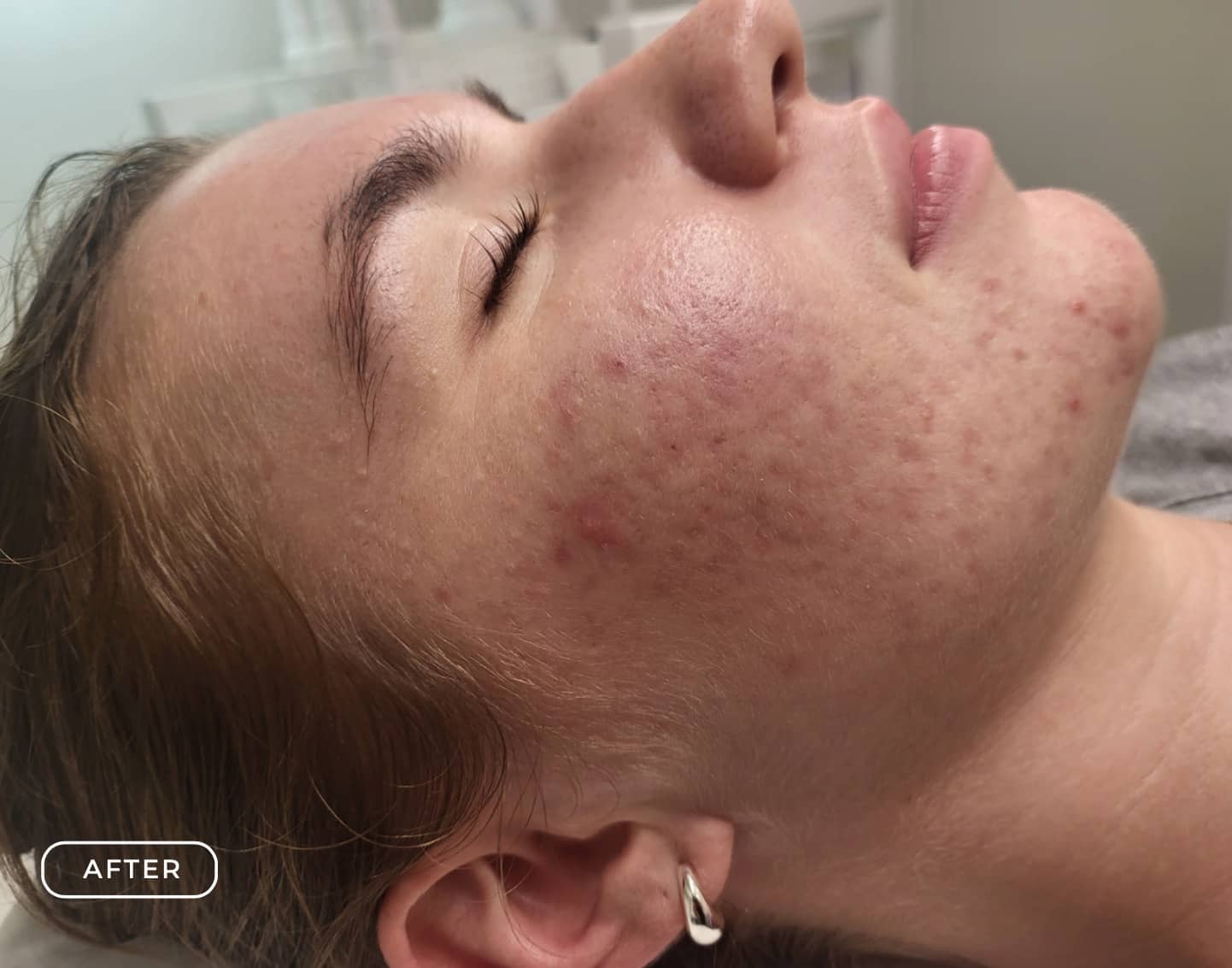 Nachher - Aknebehandlung Akne