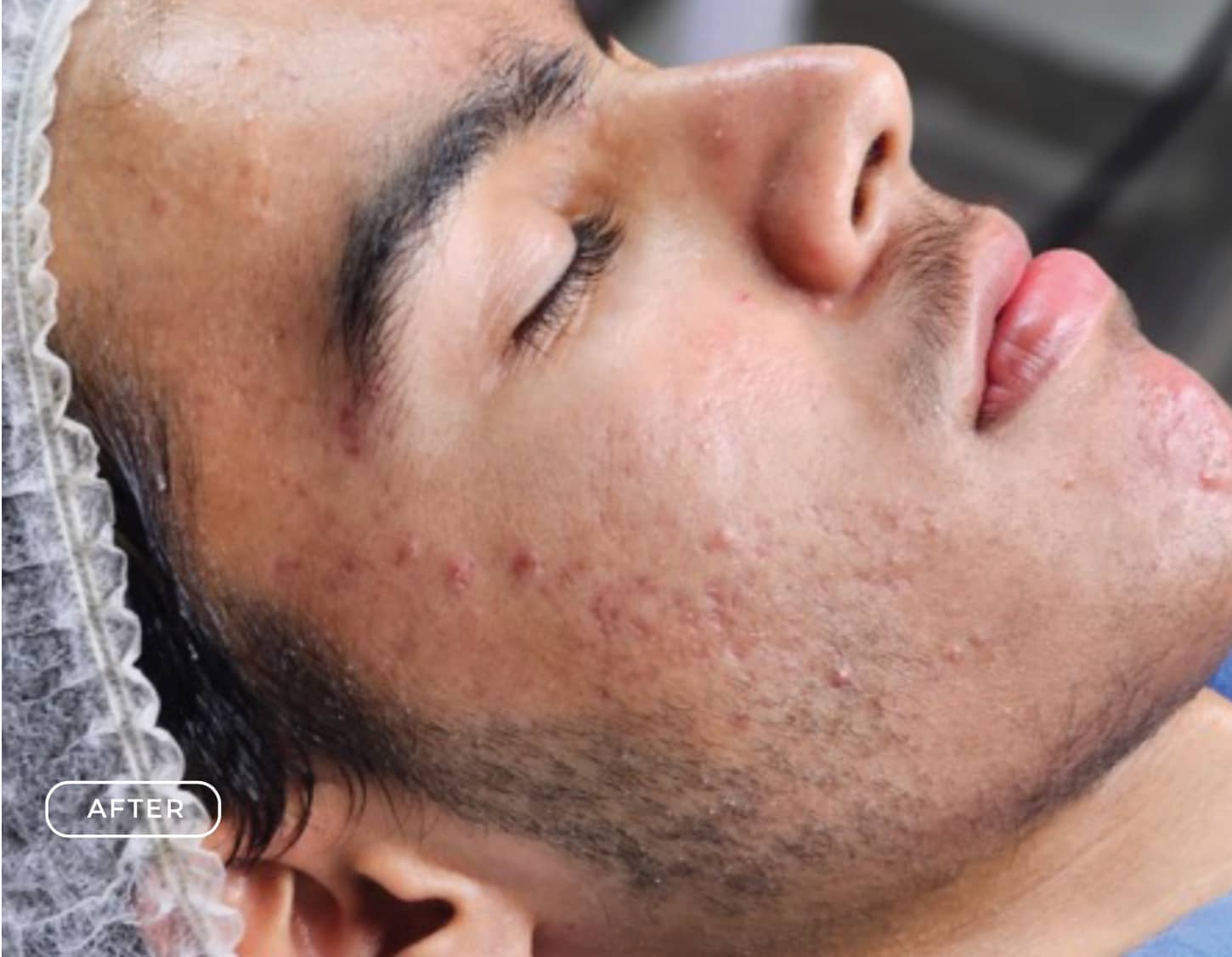 Nachher - Aknebehandlung Unreine Haut