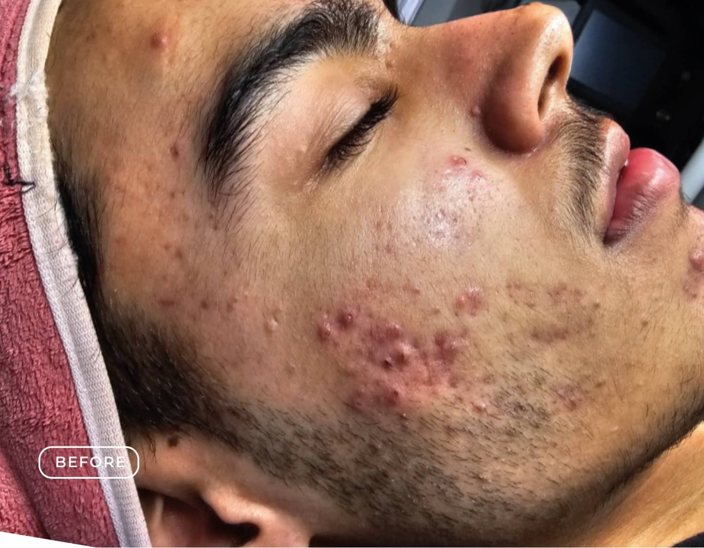 Vorher - Aknebehandlung Unreine Haut