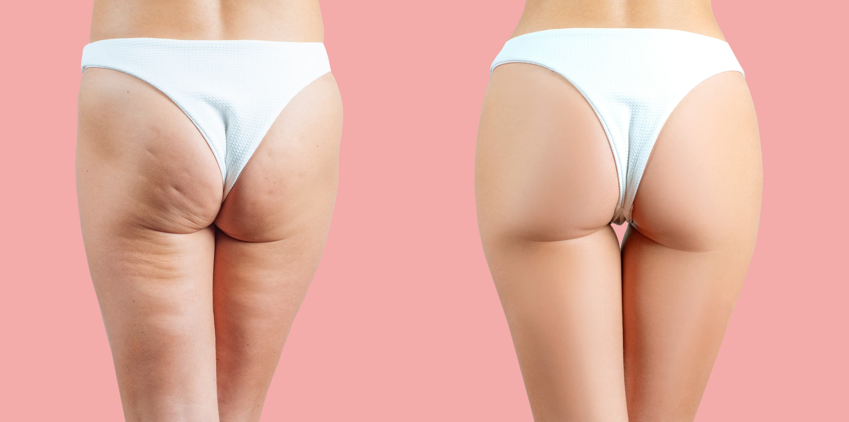 Cellulite Behandlung Frankfurt – Professionelle Anti-Cellulite-Therapie bei Embelezar
